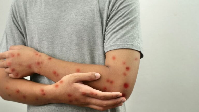 Ecuador en alerta: detectan primer caso de Mpox Clado Ib y refuerzan medidas ante riesgo de propagación